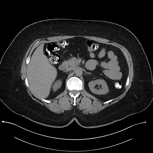 File:Carcinoid tumor - terminal ileum (Radiopaedia 60931-68740 Axial non-contrast 35).jpg