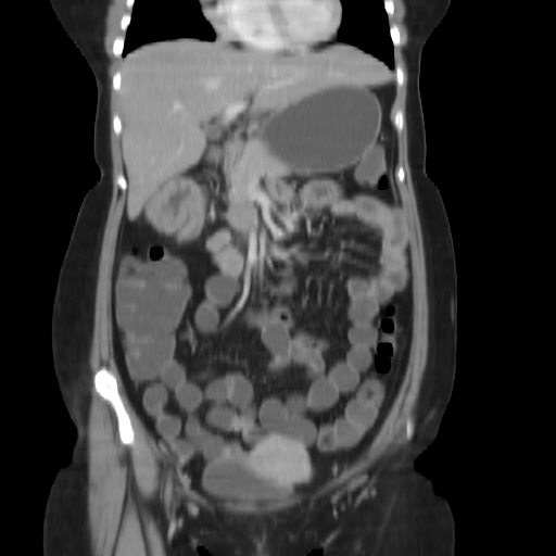 File:Carcinoma colon - hepatic flexure (Radiopaedia 19461-19493 B 14).jpg