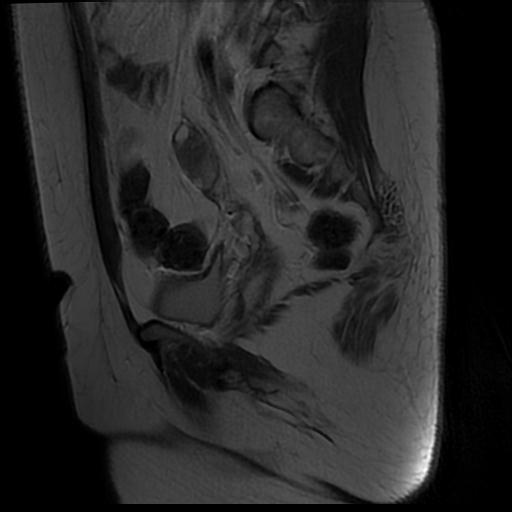 File:Carcinoma of the cervix (Radiopaedia 89018-105858 Sagittal T2 13).jpg