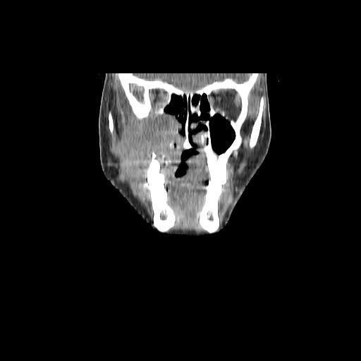 Carcinoma of the maxillary antrum (Radiopaedia 53805-59888 Coronal C+ delayed 40).jpg