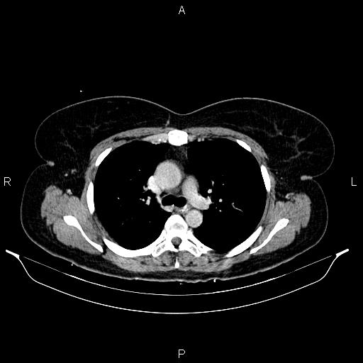 Carcinoma of uterine cervix (Radiopaedia 85861-101700 A 16).jpg