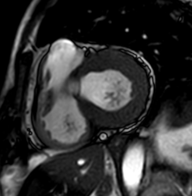 Cardiac amyloidosis - ATTR wild-type (Radiopaedia 74412-85296 short axis cine SSFP 132).jpg