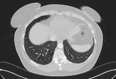 File:Cardiac sarcoidosis (Radiopaedia 74548-85534 Axial lung window 72).jpg
