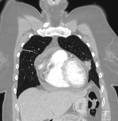 File:Cardiac sarcoidosis (Radiopaedia 74548-85534 Coronal lung window 15).jpg