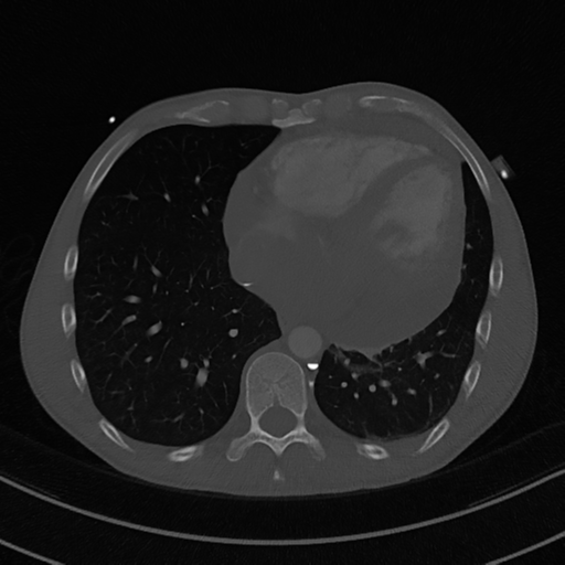 Cardiac tumor - undifferentiated pleomorphic sarcoma (Radiopaedia 45844-50134 Axial bone window 49).png