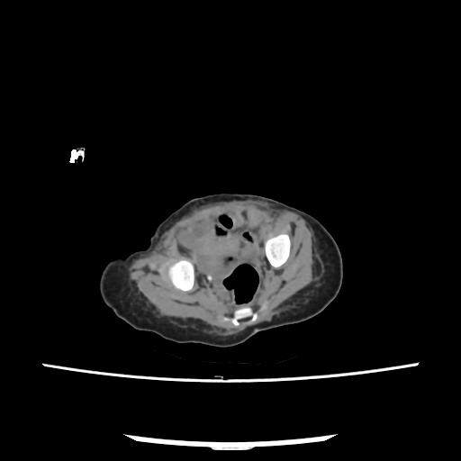 Caroli disease with autosomal recessive polycystic kidney disease (ARPKD) (Radiopaedia 89651-106703 E 211).jpg