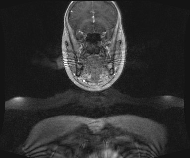 Carotid body tumor (Radiopaedia 12777-12912 MRA 1).jpg