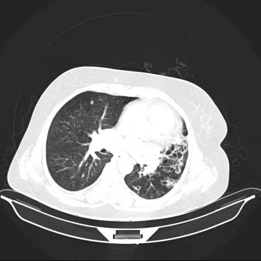 File:Carotid body tumor (Radiopaedia 21021-20948 Axial lung window 21).jpg