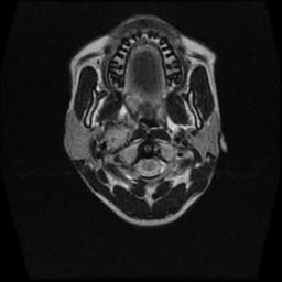 File:Carotid body tumor (Radiopaedia 30208-30823 Axial T2 14).jpg