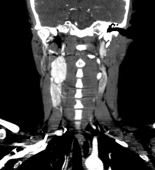 File:Carotid body tumor (Radiopaedia 39845-42300 C 43).jpg
