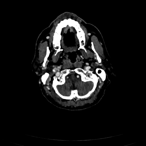 Carotid body tumor (Radiopaedia 83615-98727 D 32).jpg