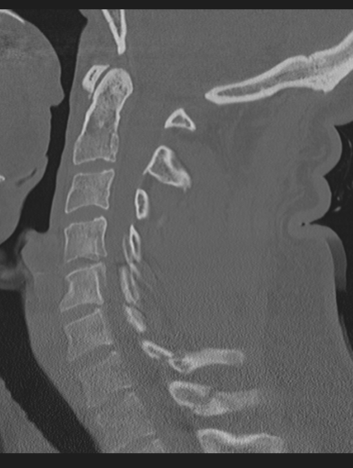 Cavernoma of cervical cord (Radiopaedia 50838-56346 Sagittal bone window 40).png