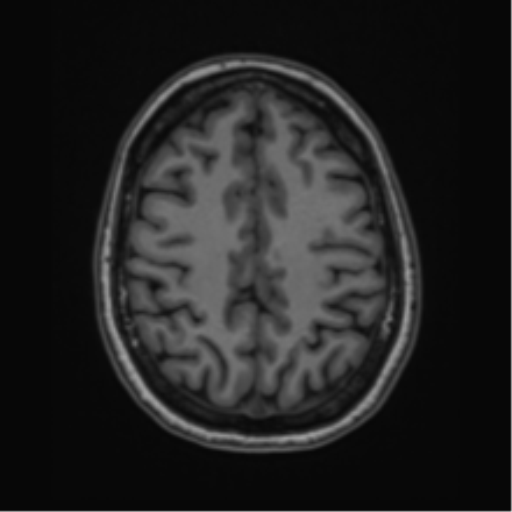 Cavernoma with bleed - midbrain (Radiopaedia 54546-60774 Axial T1 41).png