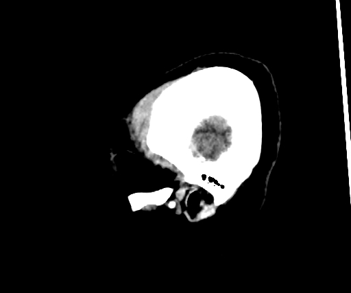 Cavernous hemangioma of the cerebellar falx (Radiopaedia 73025-83723 B 301).jpg