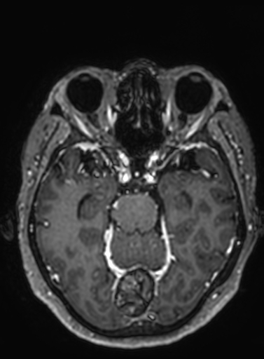 Cavernous hemangioma of the cerebellar falx (Radiopaedia 73025-83724 Axial T1 C+ 213).jpg
