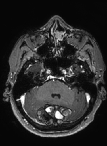 Cavernous hemangioma of the cerebellar falx (Radiopaedia 73025-83724 Axial T1 C+ 252).jpg