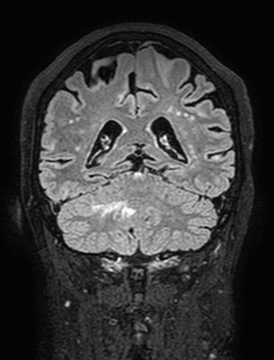 Cavernous hemangioma of the cerebellar falx (Radiopaedia 73025-83724 Coronal FLAIR 242).jpg