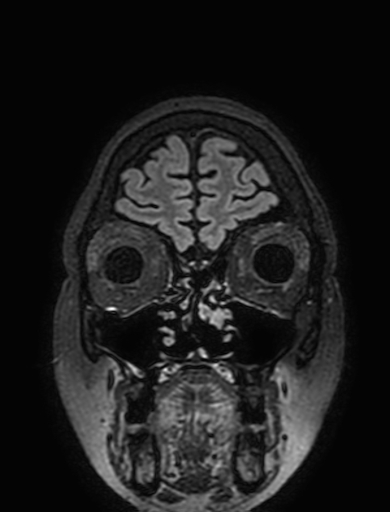 Cavernous hemangioma of the cerebellar falx (Radiopaedia 73025-83724 Coronal FLAIR 37).jpg