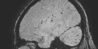 Cavernous hemangioma of the cerebellar falx (Radiopaedia 73025-83724 Sagittal BOLD 155).jpg