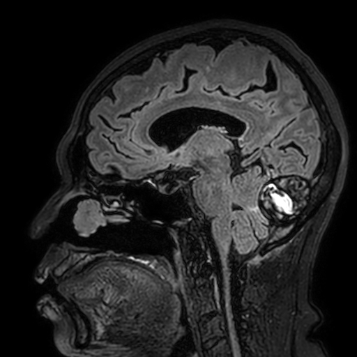 Cavernous hemangioma of the cerebellar falx (Radiopaedia 73025-83724 Sagittal FLAIR 95).jpg