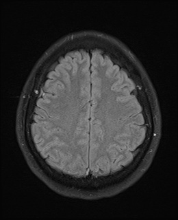 File:Cavernous sinus meningioma (Radiopaedia 63682-72367 Axial FLAIR 17).jpg