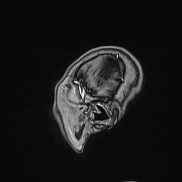 Cavernous sinus meningioma (Radiopaedia 63682-72367 Sagittal T1 C+ 160).jpg