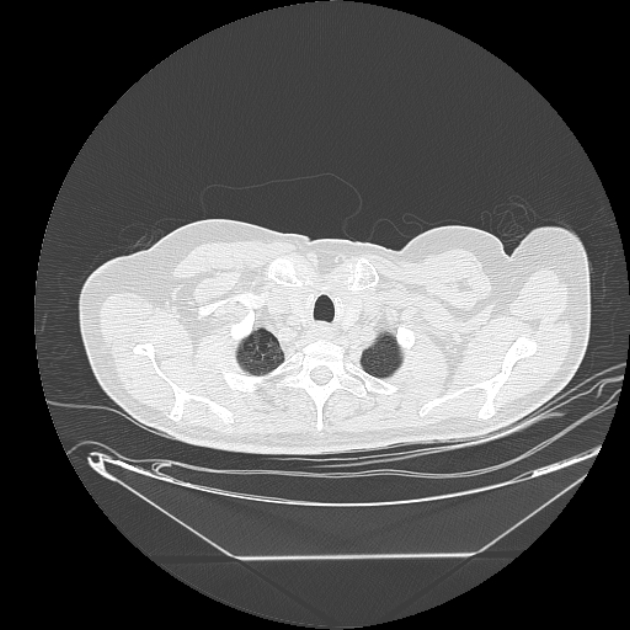 Cavitating bronchogenic carcinoma (Radiopaedia 44489-48162 Axial lung window 2).jpg