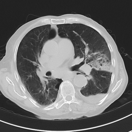Cavitating pneumonia - lingular segments (Radiopaedia 34386-35678 Axial lung window 30).png