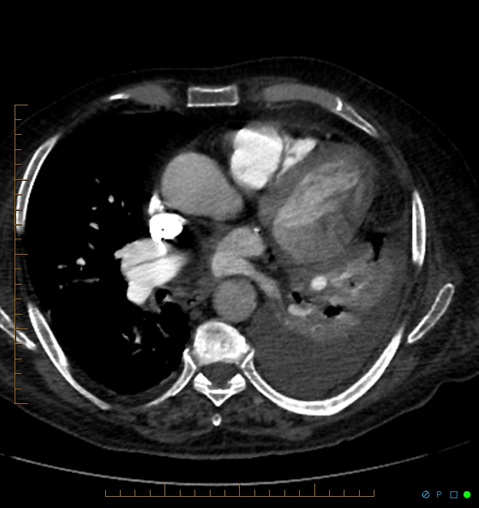 Cavitating pulmonary infarction (Radiopaedia 54634-60849 Axial C+ CTPA 45).jpg