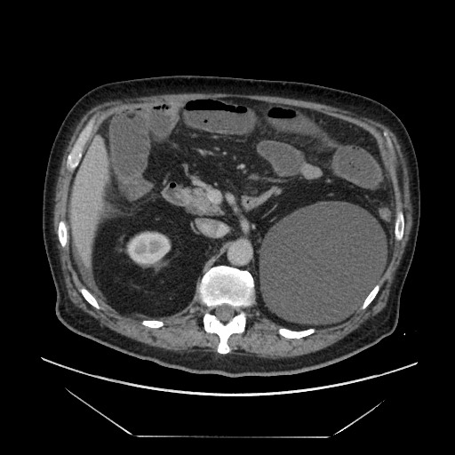 Cecal adenocarcinoma (Radiopaedia 64871-73817 A 30).jpg
