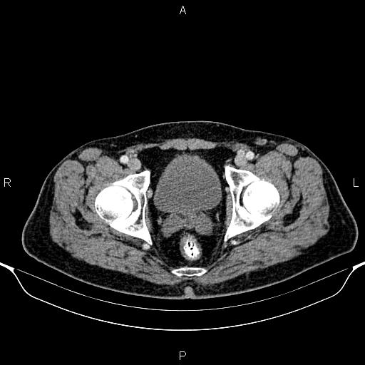 Cecal adenocarcinoma (Radiopaedia 85324-100916 B 94).jpg