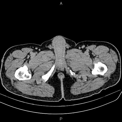 File:Cecal cancer with appendiceal mucocele (Radiopaedia 91080-108651 Axial C+ delayed 96).jpg