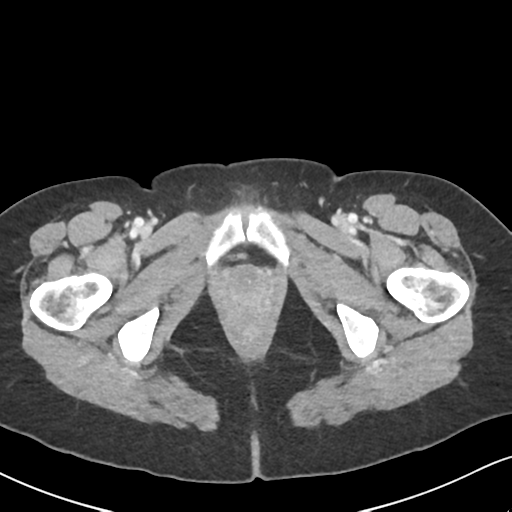 Cecal internal hernia through the foramen of Winslow (Radiopaedia 44820-48651 B 80).png