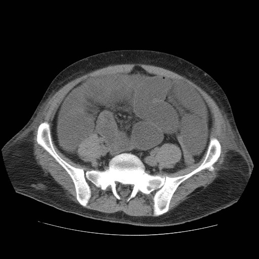 Cecal volvulus (Radiopaedia 28294-28534 Axial non-contrast 71).jpg