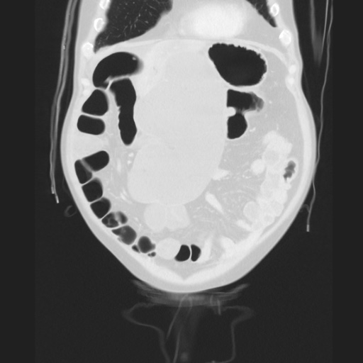 Cecal volvulus (Radiopaedia 75378-86620 Coronal lung window 43).jpg