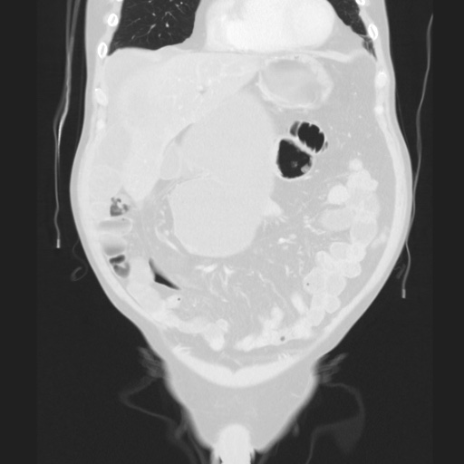 Cecal volvulus (Radiopaedia 75378-86620 Coronal lung window 51).jpg