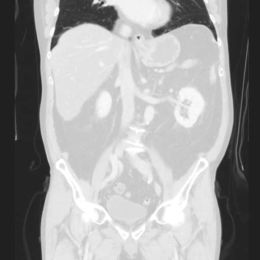 Cecal volvulus (Radiopaedia 75378-86620 Coronal lung window 78).jpg