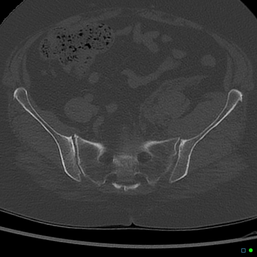 File:Central fracture-dislocation of the acetabulum (Radiopaedia 36578-38150 Axial bone window 17).jpg