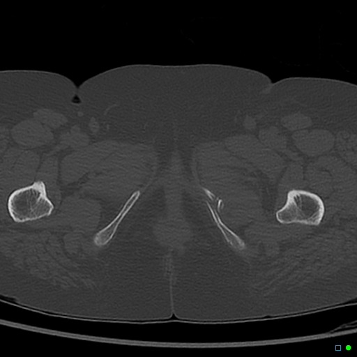 Central fracture-dislocation of the acetabulum (Radiopaedia 36578-38150 Axial bone window 89).jpg