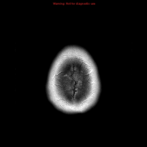 File:Central nervous system vasculitis (Radiopaedia 8410-9235 Axial T1 C+ 24).jpg