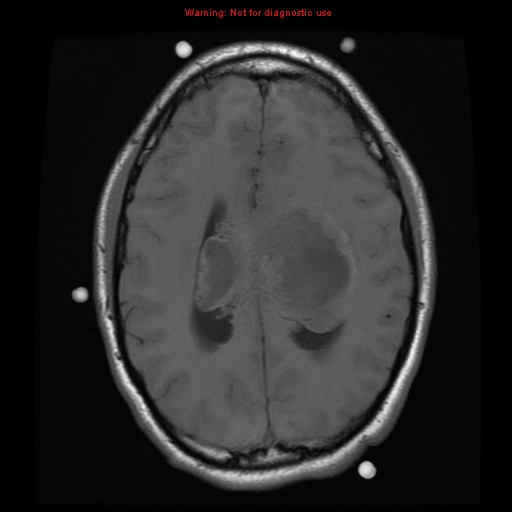File:Central neurocytoma (Radiopaedia 13188-13206 Axial T1 6).jpg