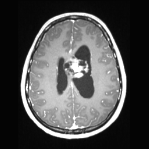 File:Central neurocytoma (Radiopaedia 37664-39557 Axial T1 C+ 53).png