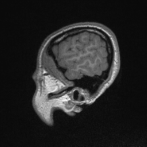 Central neurocytoma (Radiopaedia 37664-39557 Sagittal T1 84).png