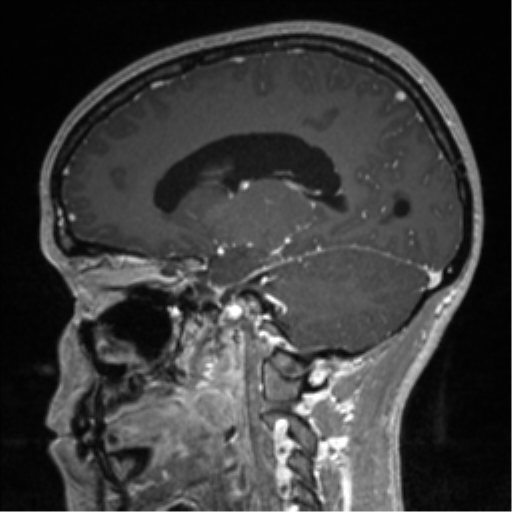 Central neurocytoma (Radiopaedia 37664-39557 Sagittal T1 C+ 59).png