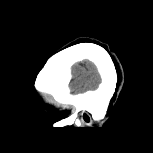 File:Central neurocytoma (Radiopaedia 65317-74346 C 8).png