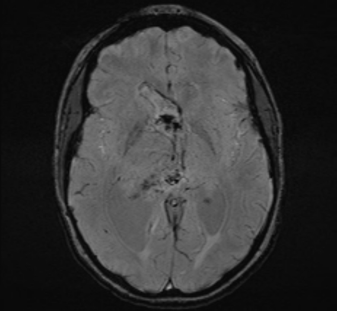 Central neurocytoma (Radiopaedia 70263-80336 Axial SWI 28).jpg
