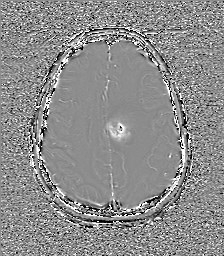 Central neurocytoma (Radiopaedia 84497-99872 Axial 52).jpg