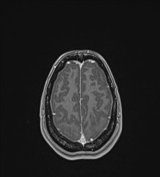 Central neurocytoma (Radiopaedia 84497-99872 Axial T1 C+ 130).jpg
