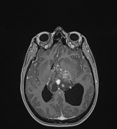 Central neurocytoma (Radiopaedia 84497-99872 Axial T1 C+ 82).jpg