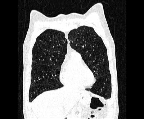 Centrilobular pulmonary emphysema (Radiopaedia 62468-70718 Coronal lung window 18).jpg